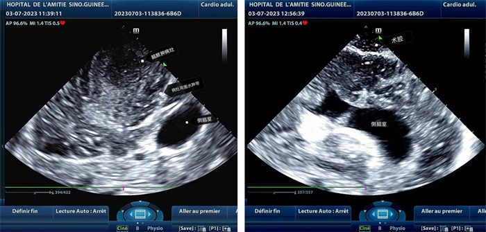 左圖顯示術中超聲見囊實性病變，大小約為4x4x3cm，病灶周圍腦組織水腫明顯；右圖為病灶切除后，術中超聲示術腔無病變殘留