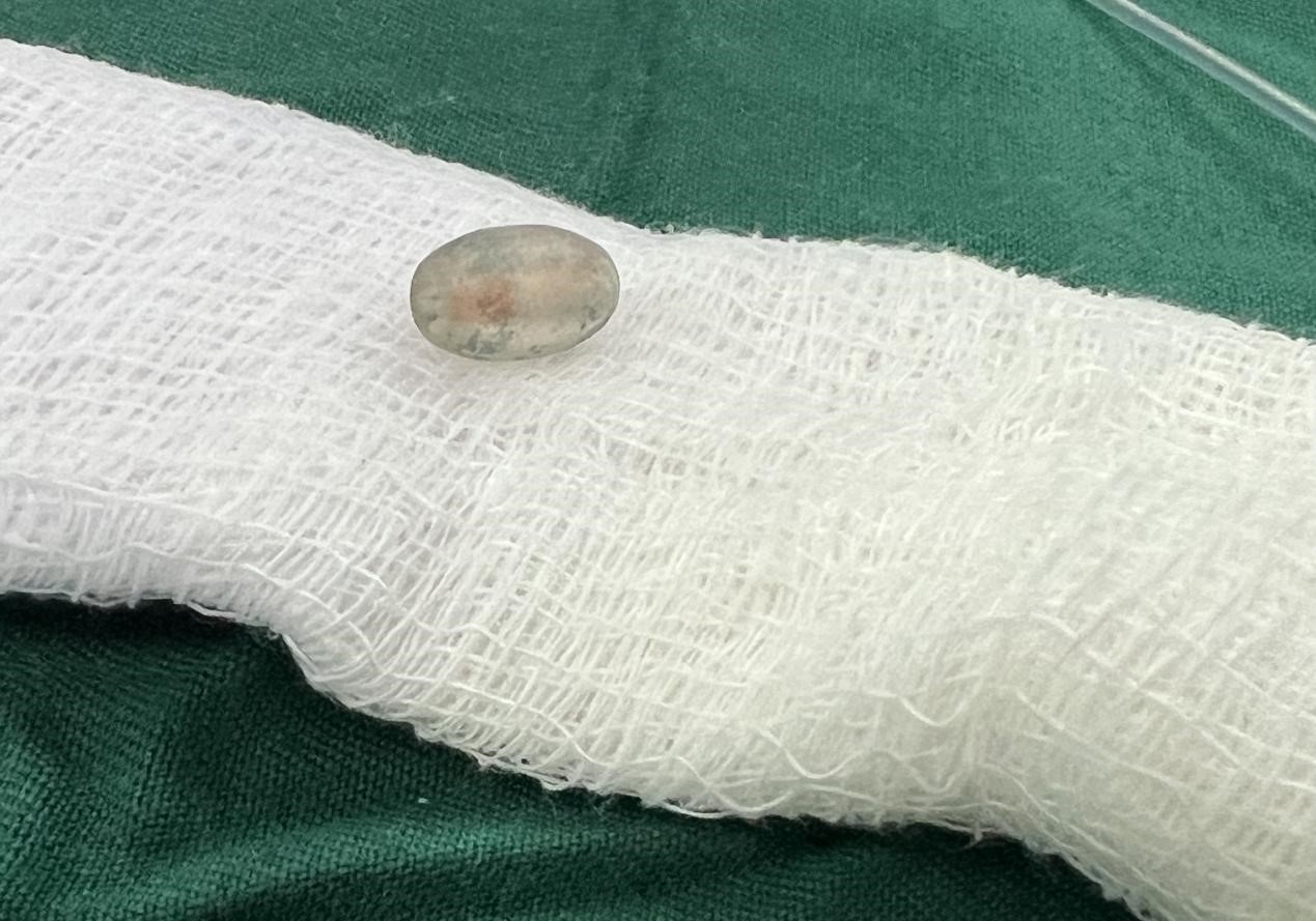 被取出的異物。中國援桑醫(yī)療隊供圖